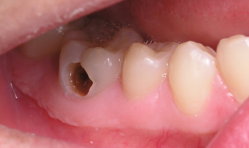 Tùy vào mức độ răng sâu mà bác sĩ sẽ có chỉ định phù hợp