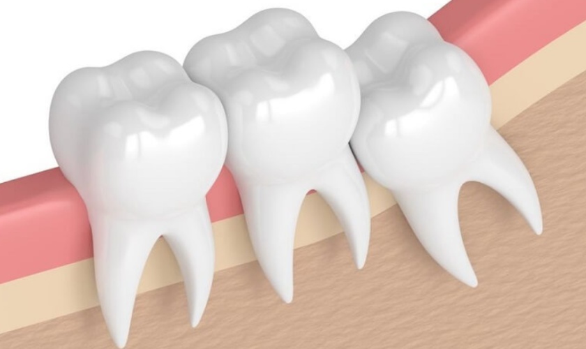 Răng khôn mọc lệch nếu không nhổ kịp thời sẽ gây nên nhiều biến chứng nguy hiểm