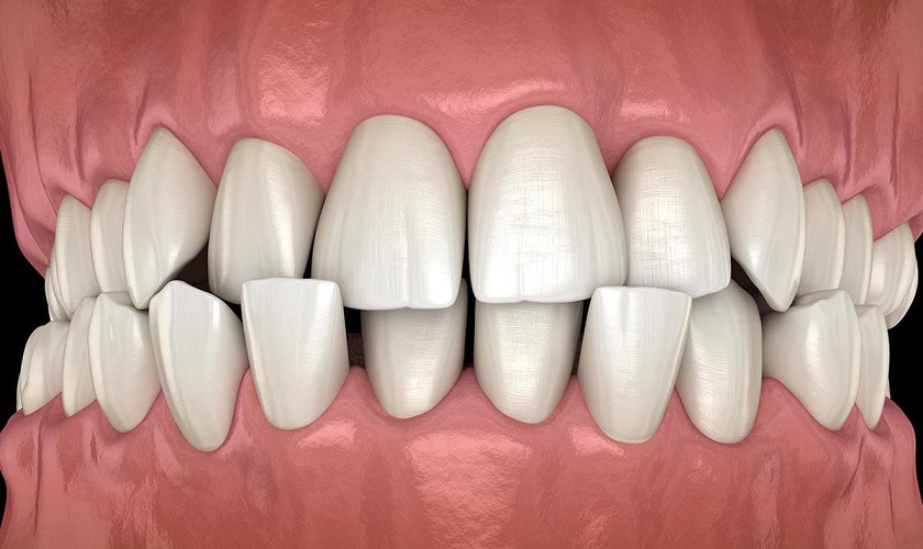  Nhổ răng mọc lệch hàm dưới : Nguyên nhân, triệu chứng và cách chăm sóc