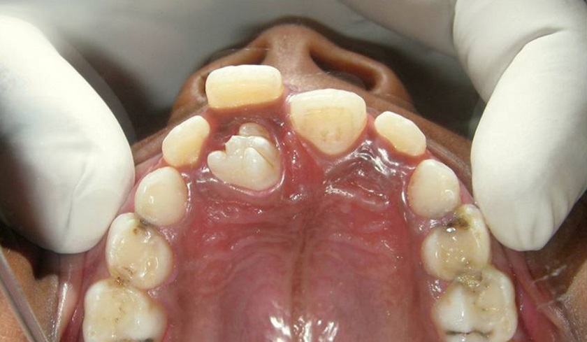 Có nhiều lý thuyết cho tình trạng răng mọc thừa Có nhiều lý thuyết cho tình trạng răng mọc thừa