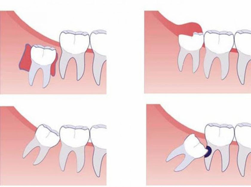 Các kiểu mọc răng khôn
