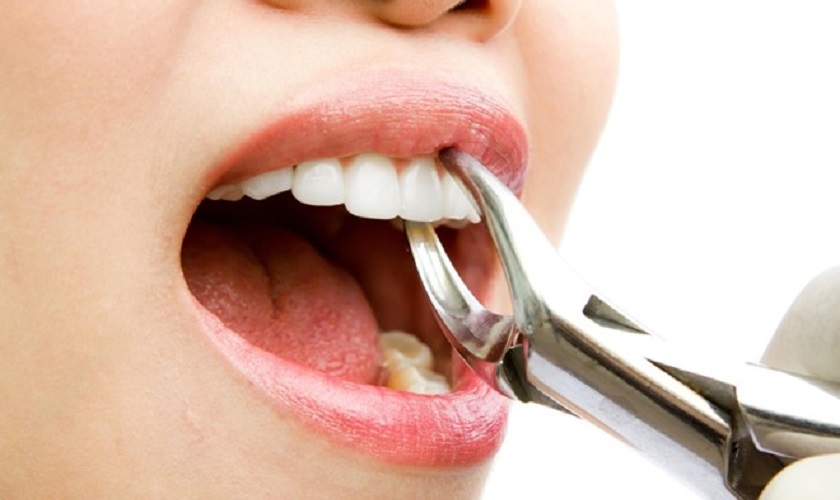 Giải đáp băn khoăn: Nhổ răng nào nguy hiểm nhất?