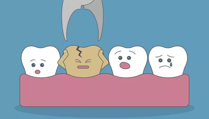 Nhổ răng số 7 được chỉ định khi răng đã hư hỏng nặng