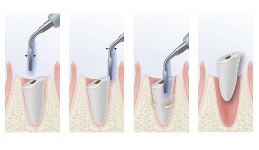 Nhổ răng bằng sóng siêu âm không gây đau nhức