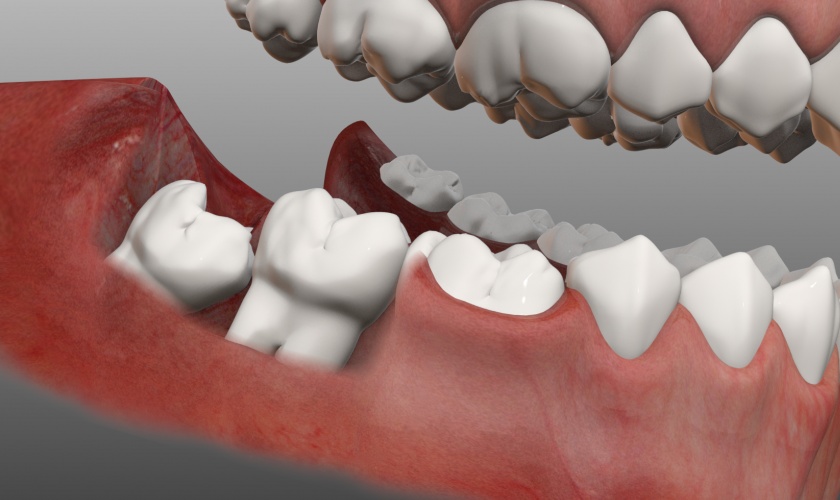 Răng khôn mọc lệch, mọc ngầm gây nên nhiều biến chứng nguy hiểm
