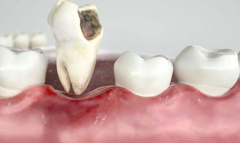 Răng khôn làm ảnh hưởng tới những chiếc răng bên cạnh