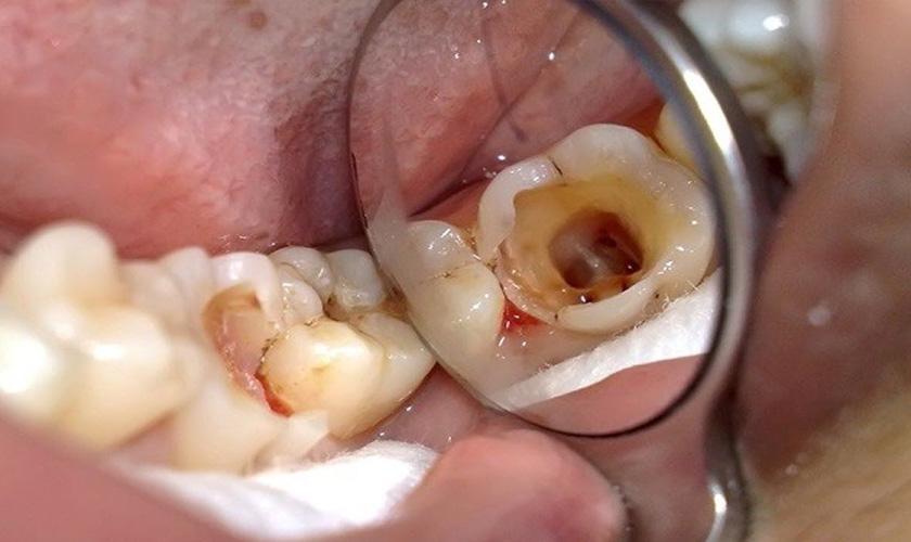 Răng sâu nặng không thể điều trị thì cần phải nhổ bỏ