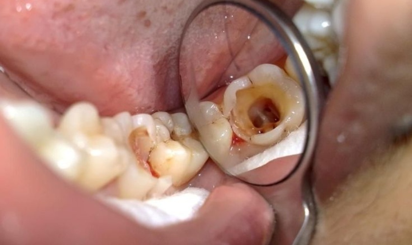 Răng sâu, vỡ lớn cần thực hiện nhổ bỏ