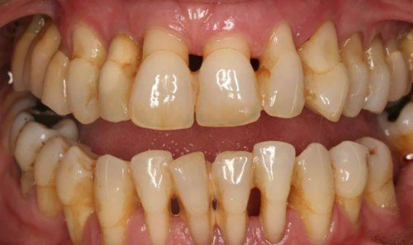 Răng bị viêm nha chu nặng cần nhổ bỏ để bảo vệ sức khỏe răng miệng