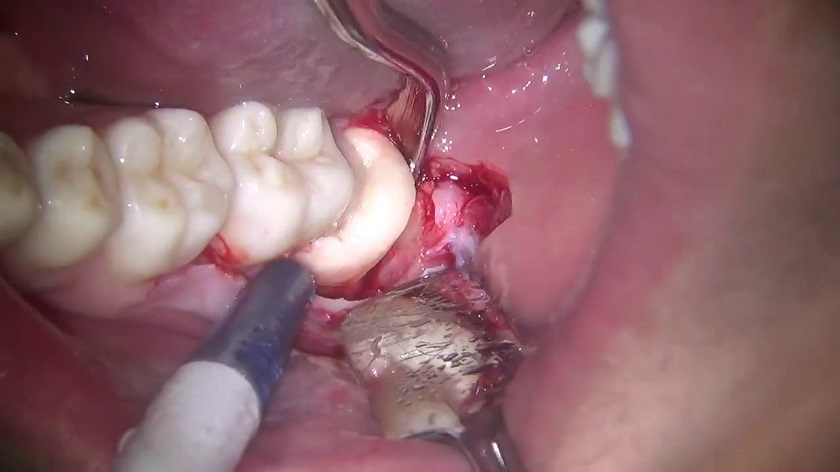 Nhổ răng hàm dưới phức tạp hơn các răng khác