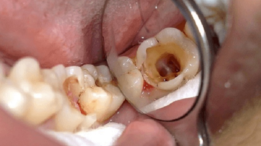 Răng hàm bị sâu nặng