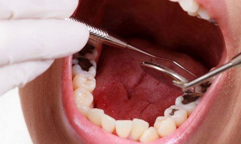 Có những nguy cơ nhiễm trùng nào có thể xảy ra sau khi nhổ răng cấm hàm dưới?

