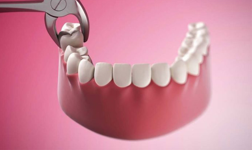 Địa chỉ nhổ răng khôn an toàn và không đau ở đâu ?