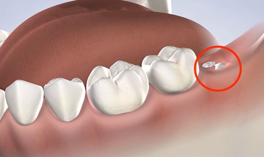 Phí nhổ răng khôn sẽ phụ thuộc rất nhiều vào vị trí mọc của răng