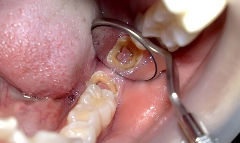 Răng khôn mọc lệch có thể dẫn đến tình trạng sâu răng