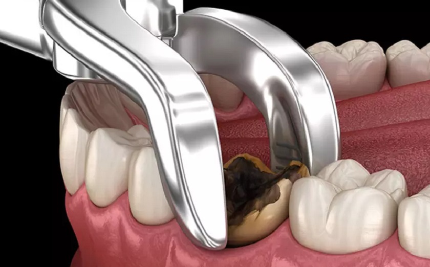Cần tiến hành nhổ răng khi răng đã bị sâu nặng