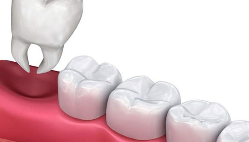 Những trường hợp chống chỉ định nhổ răng