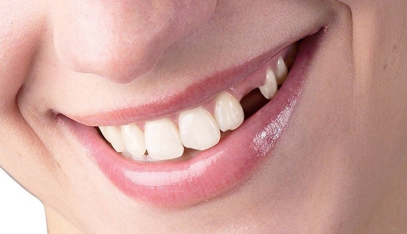 Nhổ răng nanh có gây ảnh hưởng gì không?