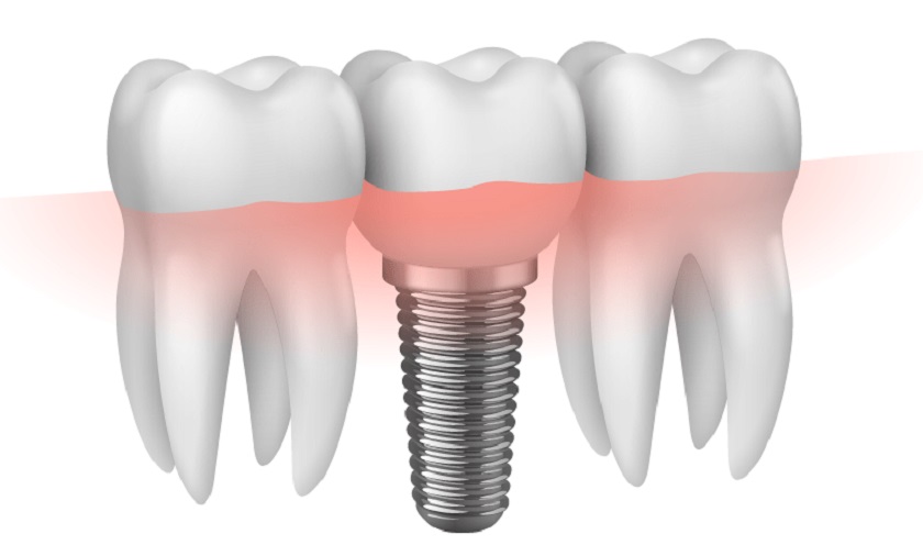 Trồng răng Implant khôi phục toàn diện răng đã mất