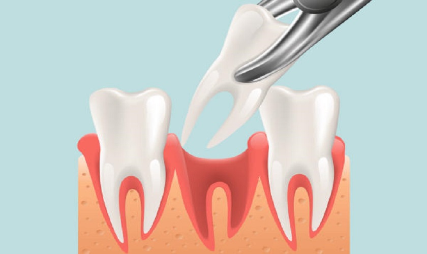 Tất tần tật về nhổ răng số 7 bao lâu thì lành mà bạn cần biết