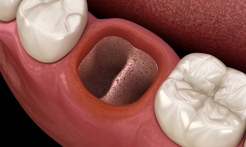 Sau khi nhổ răng số 7, tại sao cần trồng lại răng?

