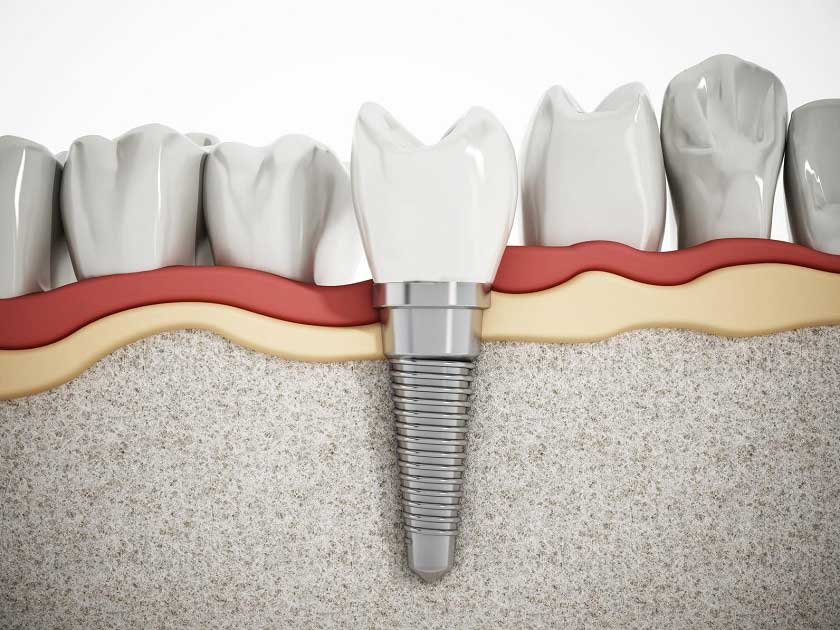 Phương pháp trồng răng implant răng số 7