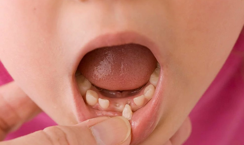  Chân răng sữa : Tất cả những gì bạn cần biết