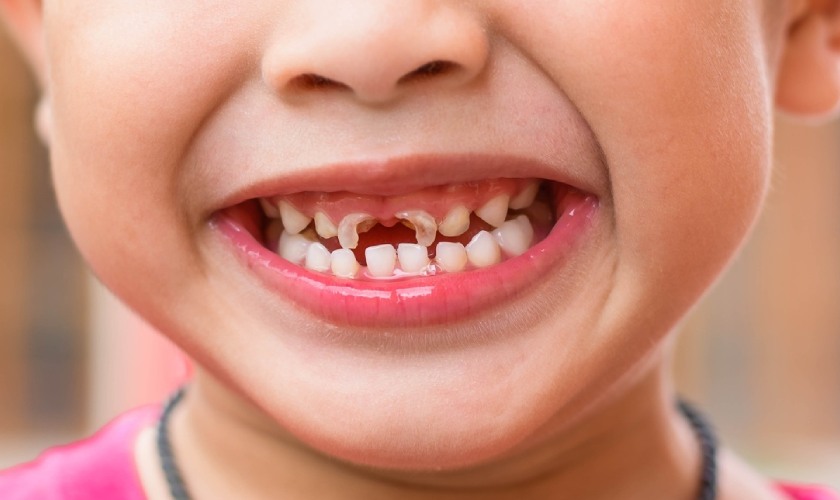 Răng sữa bị sâu nặng cần phải nhổ bỏ