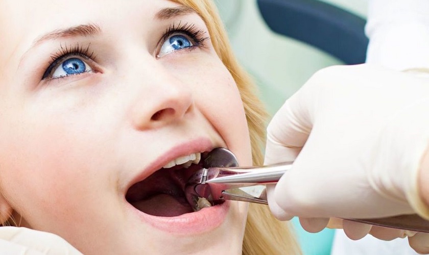 Nhổ răng khôn hàm trên