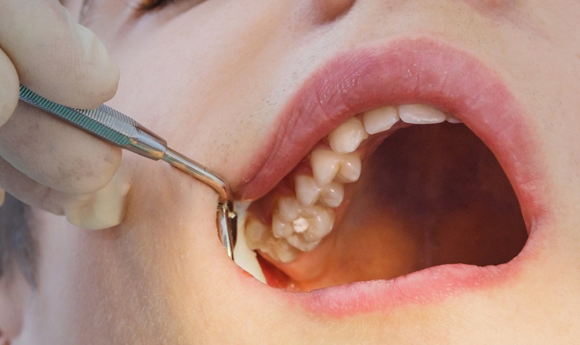 Nhổ răng trong cùng hàm trên có phức tạp hay không?