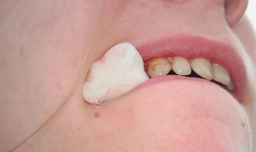 Cần cắn chặt miếng gạc để cầm máu sau khi nhổ răng khôn