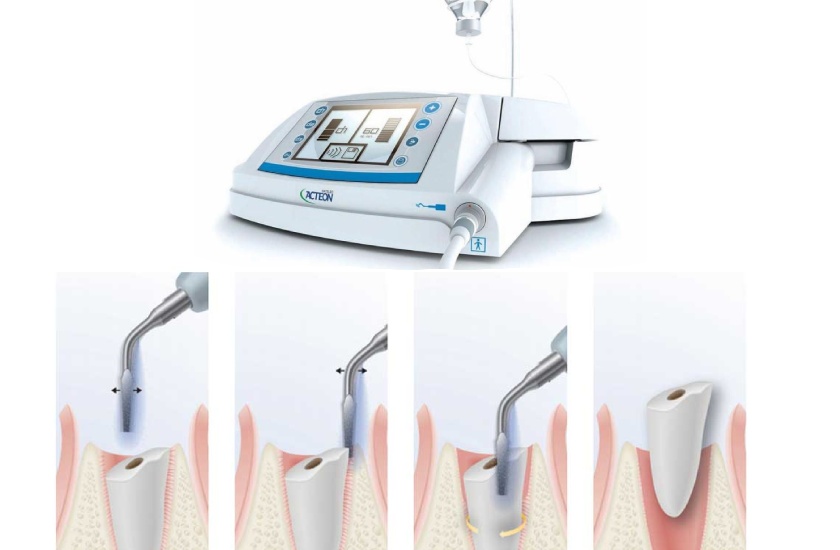 Nha khoa Nhân Tâm ứng dụng công nghệ nhổ răng khôn Piezotome