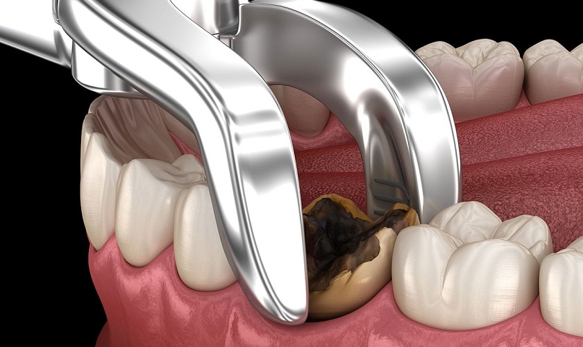 Có phương pháp nào khác nhổ răng hàm không tốn thời gian chăm sóc sau sinh?
