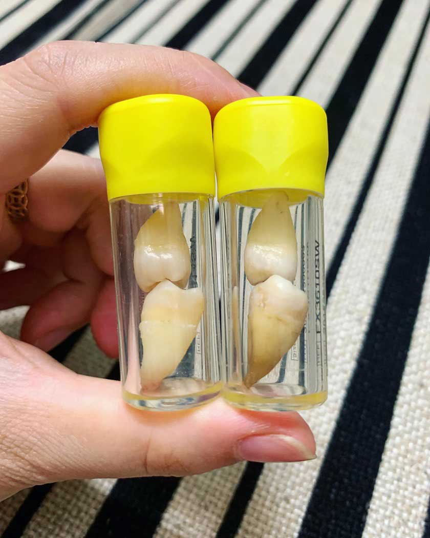 Những chiếc răng khôn mọc dại