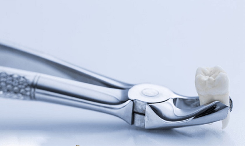 Nhổ răng có nguy hiểm không?