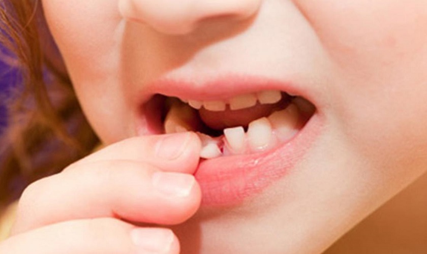 Những vấn đề phổ biến về tự nhổ răng số 8 tại nhà và cách giải quyết chúng