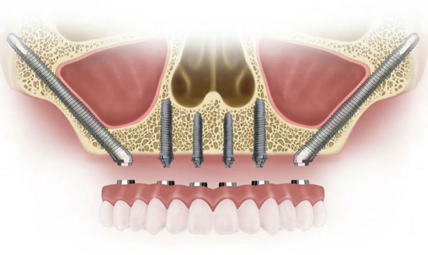 Trồng răng Implant là biện pháp điều trị có xâm lấn trong nha khoa