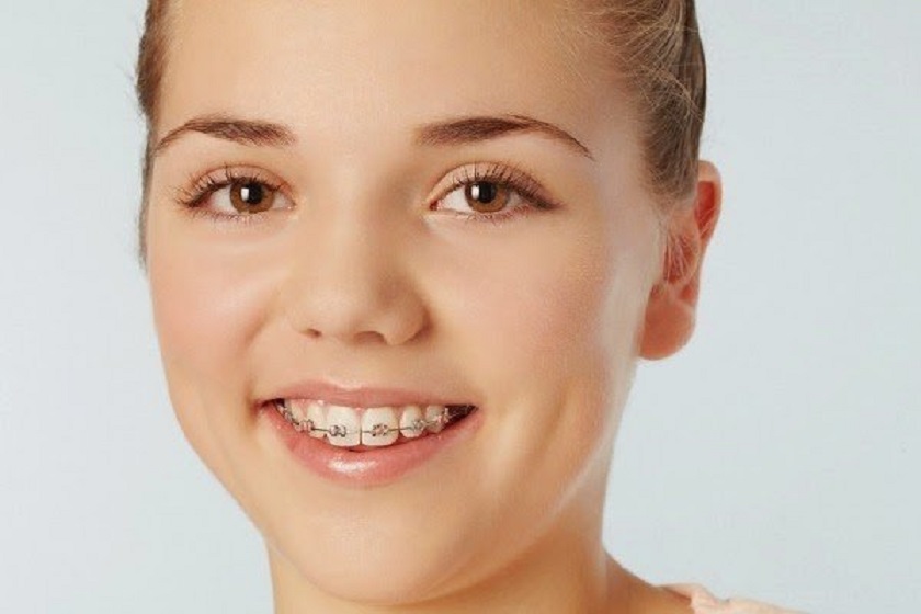 Các bác sĩ khuyên bạn nên niềng cả hàm thay vì chỉ niềng 4 răng