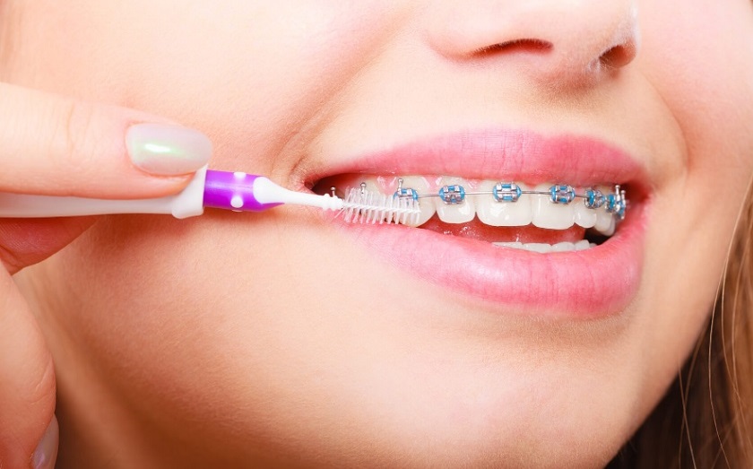 Vệ sinh, chăm sóc răng miệng cẩn thận khi đeo niềng