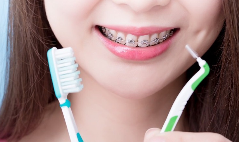 Vệ sinh khi niềng răng là rất quan trọng