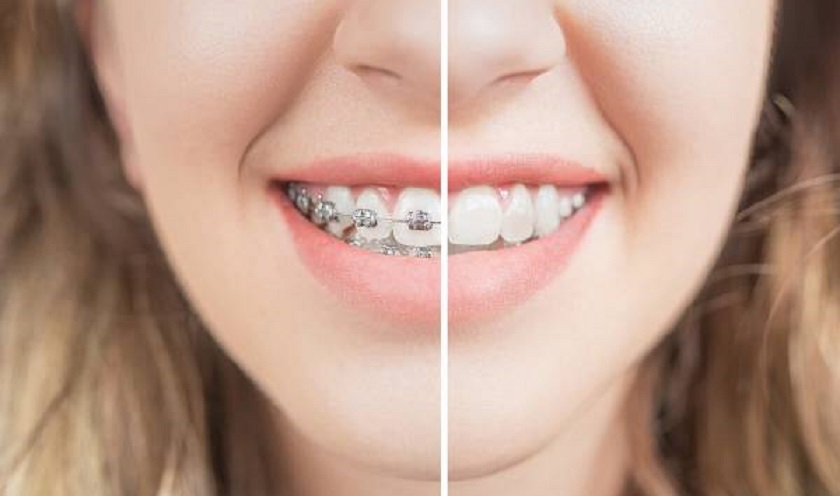 Niềng răng giúp bạn lấy lại nụ cười tự tin với hàm răng đều đẹp