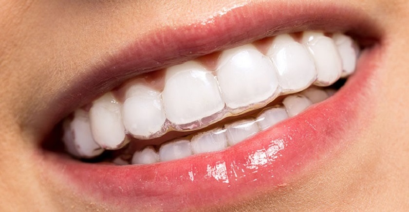 Niềng răng trong suốt đảm bảo thẩm mỹ tối ưu trong quá trình chỉnh nha