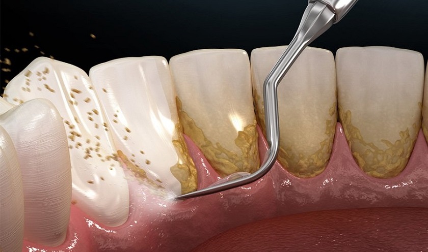 Cạo vôi răng và chữa trị các vấn đề răng miệng trước khi đeo niềng