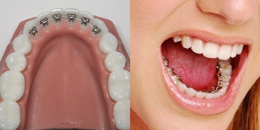 Niềng răng mắc cài mặt trong đem lại tính thẩm mỹ cao