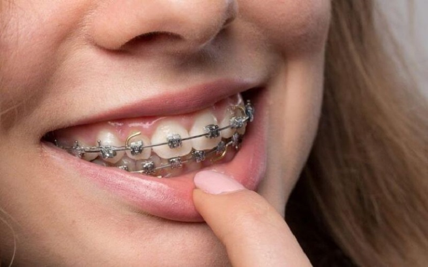 Mức độ sai lệch răng lớn thì chi phí niềng răng sẽ cao hơn các trường hợp nhẹ