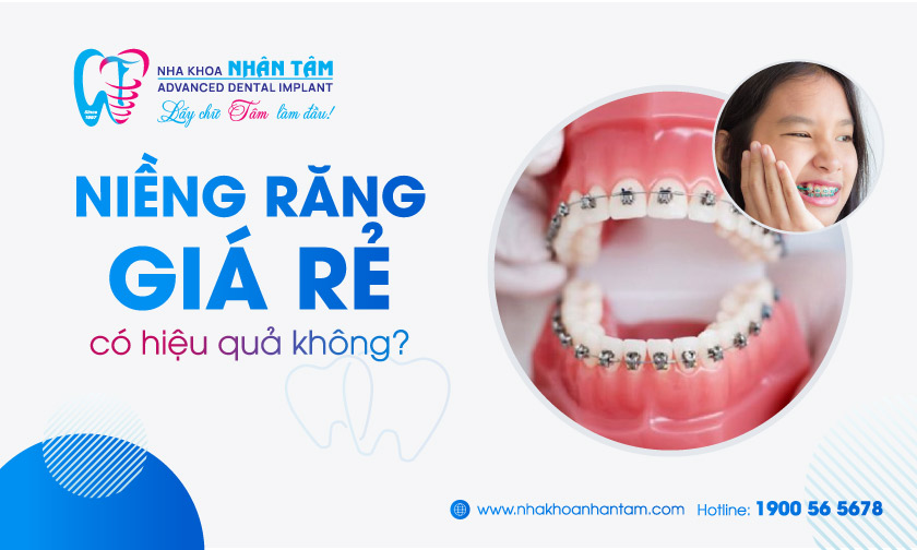 Thận trọng khi niềng răng giá quá rẻ