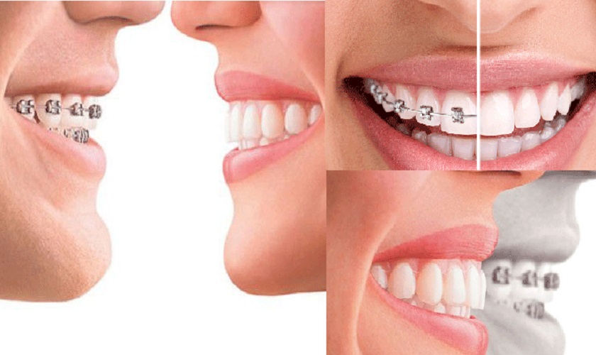 Niềng răng sứ có thực hiện được không còn tùy vào từng trường hợp