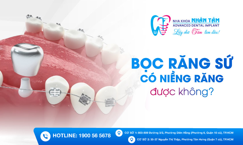 Có thể thực hiện niềng răng sứ được hay không?