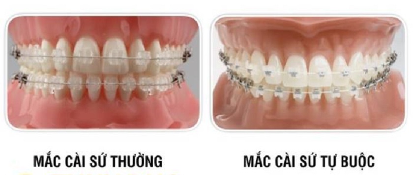 Niềng răng sứ thường và niềng răng sứ tự buộc