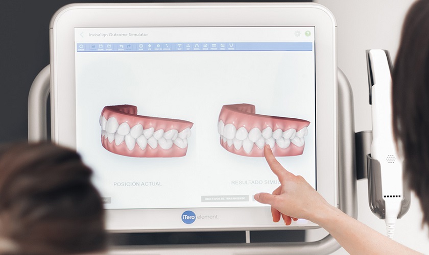 Biết trước kết quả niềng nhờ công nghệ kỹ thuật số hiện đại